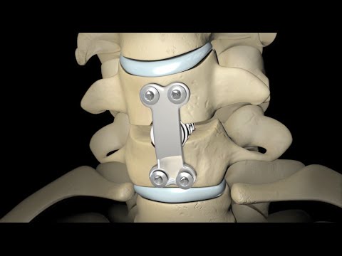 Spinal Fusion (2010)